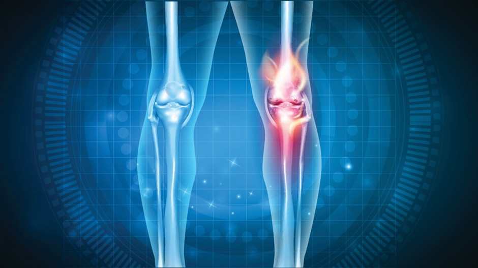 Osteoarthritis Treatment in Mohali