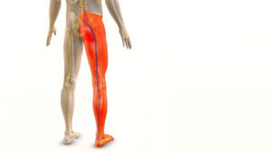 Sciatica Treatment in Mohali