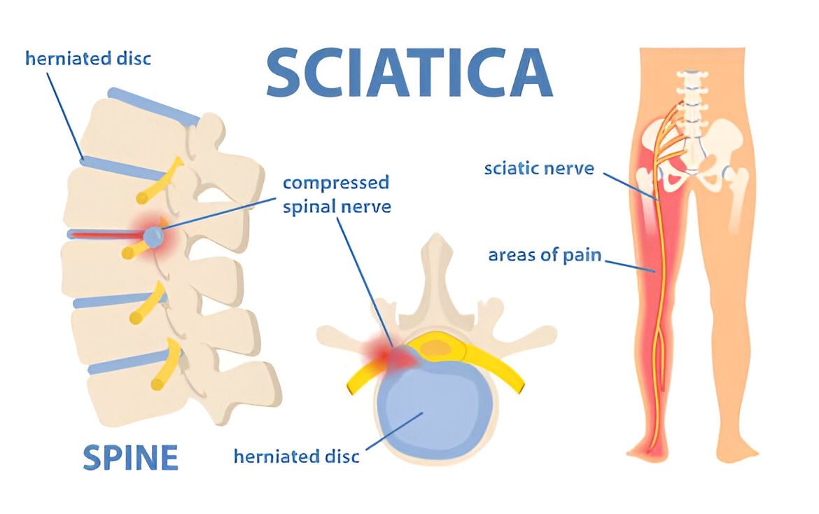 Sciatica Treatment in Mohali