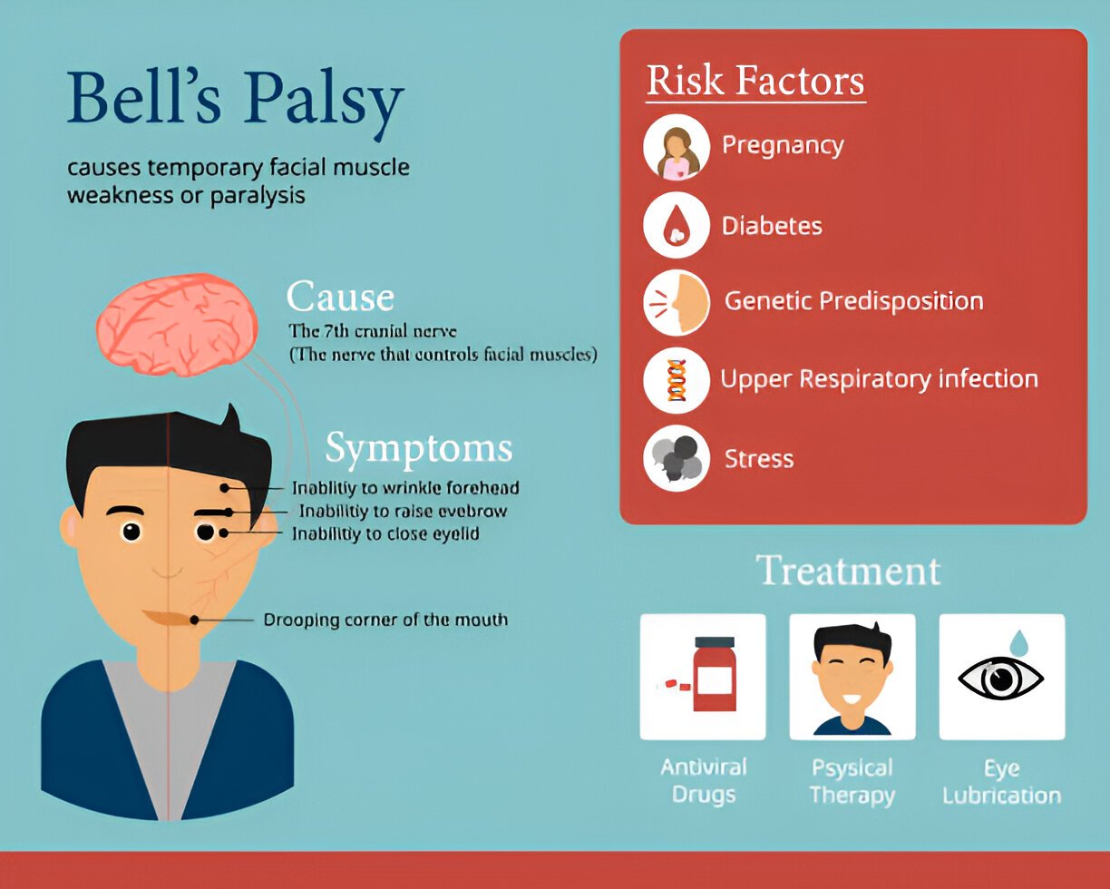 Facial palsy