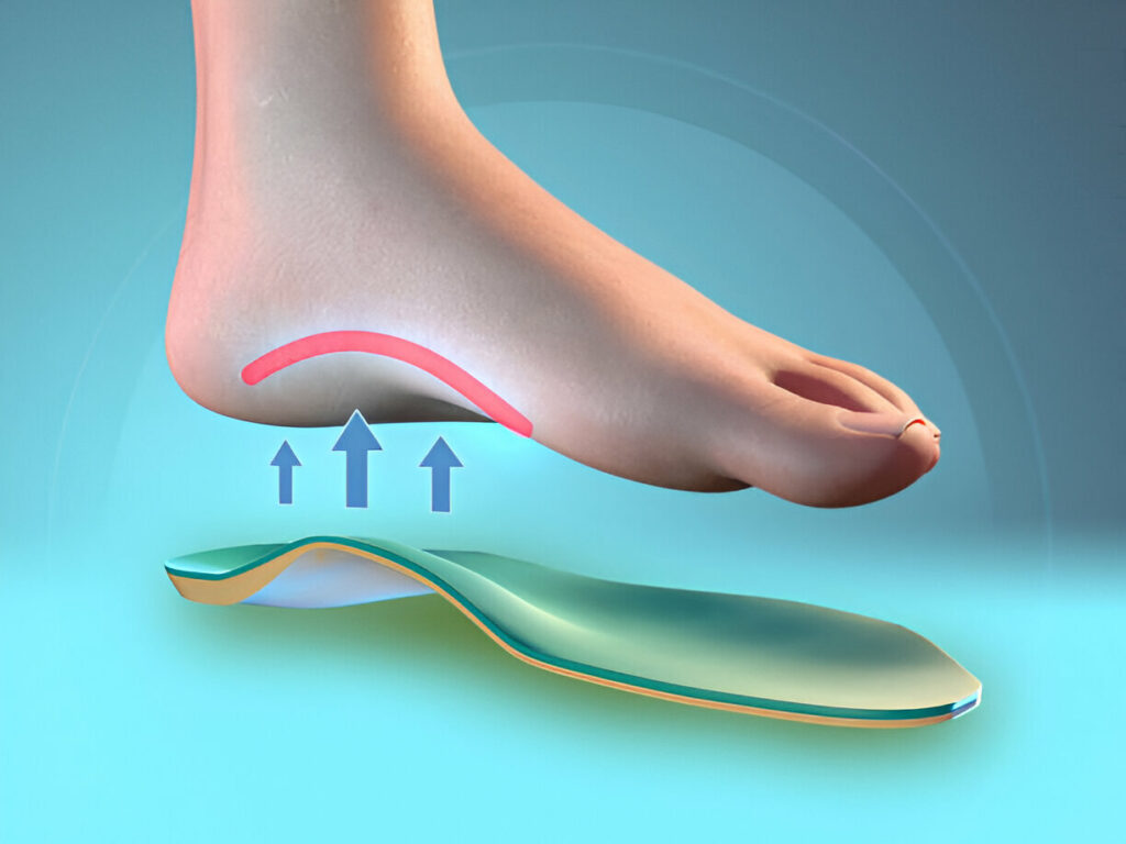 plantar fasciitis