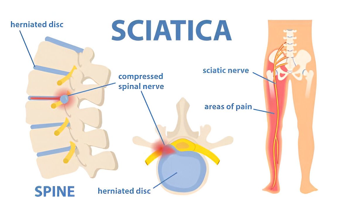 Sciatica Treatment in Mohali