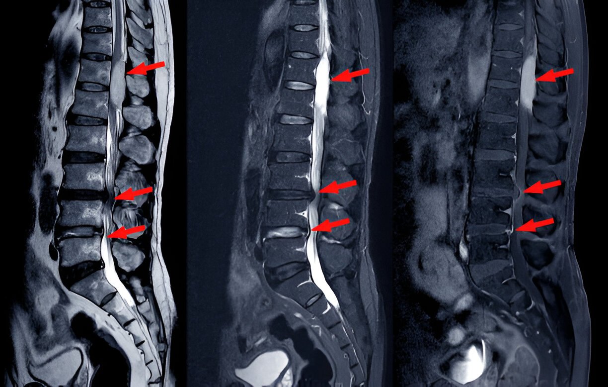 Canal stenosis in lumbar spondylitis