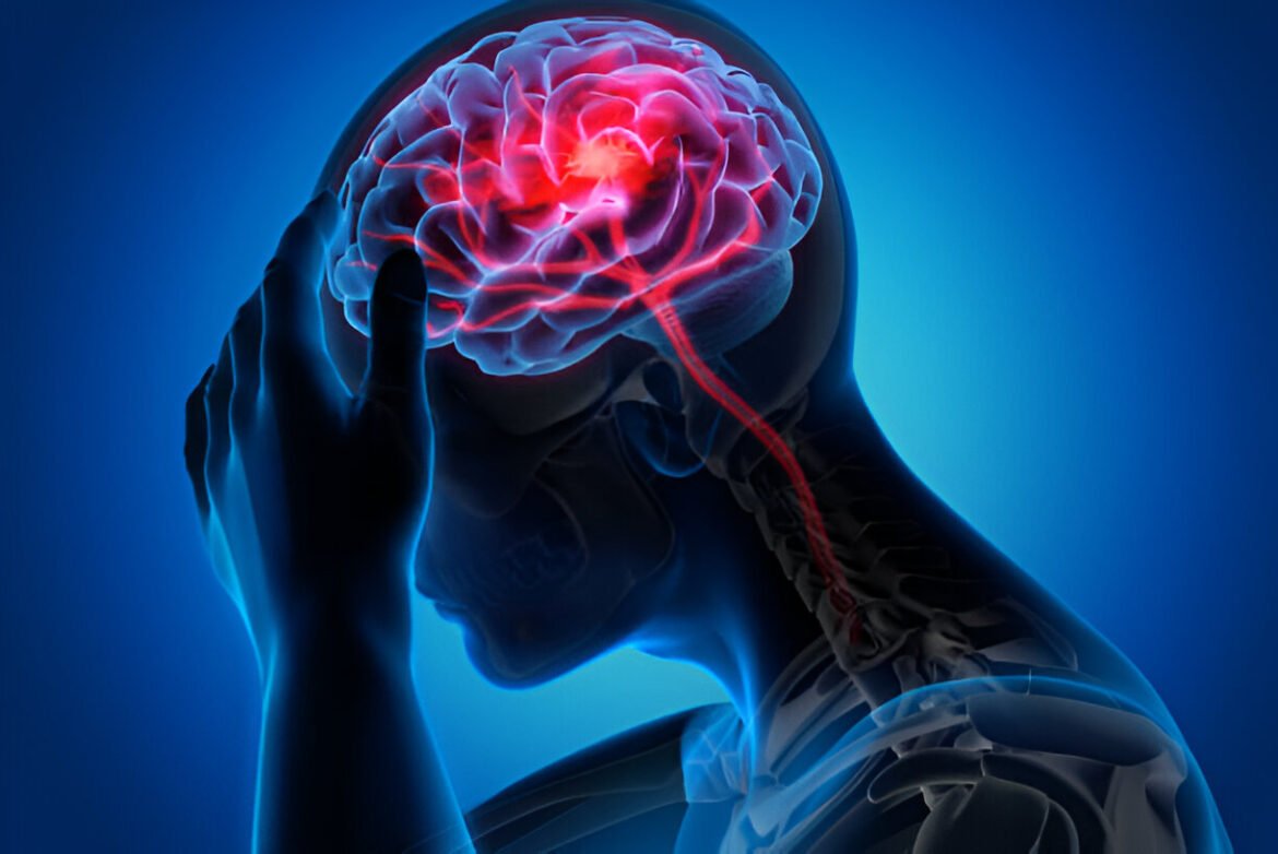 Brain Stroke 🧠 Treatment