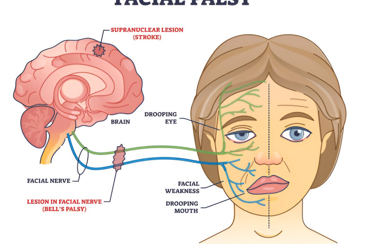 Facial palsy Treatment
