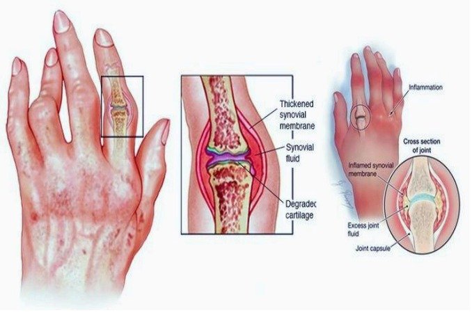 Rheumatoid Arthritis Treatment in Mohali: Regain Mobility & Comfort with Brar’s Physio Care